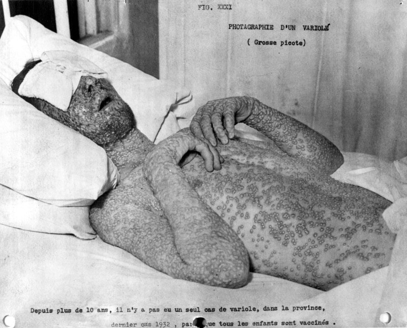 smallpox victims